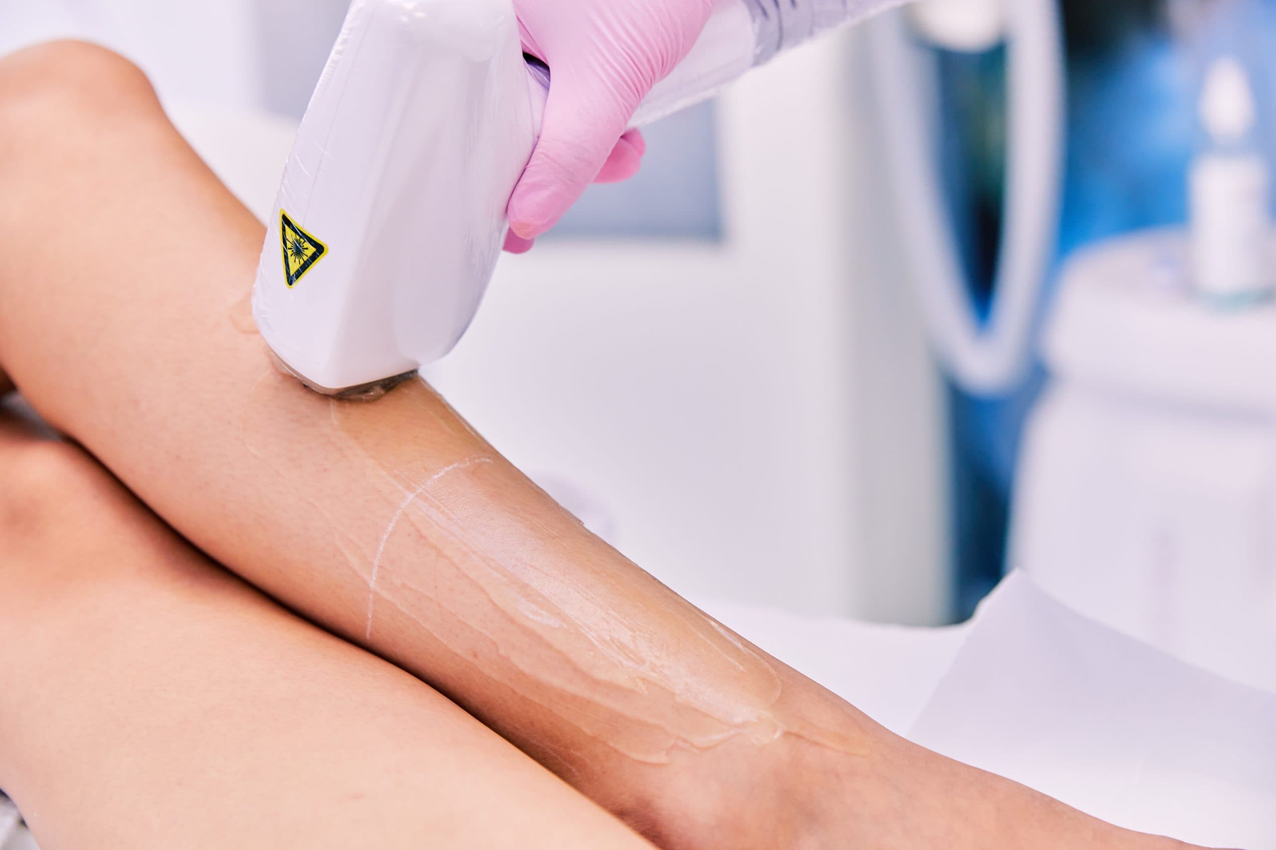 Epilare laser - zonă mare